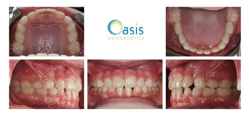 Early Care after orthodontic treatment