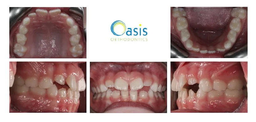 Early Care before orthodontic treatment