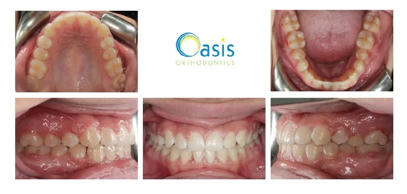Crowded Teeth after orthodontic treatment