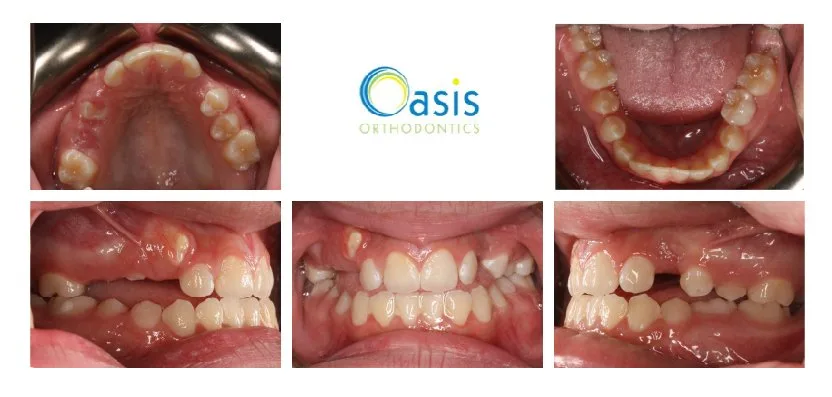 Crowded Teeth before orthodontic treatment