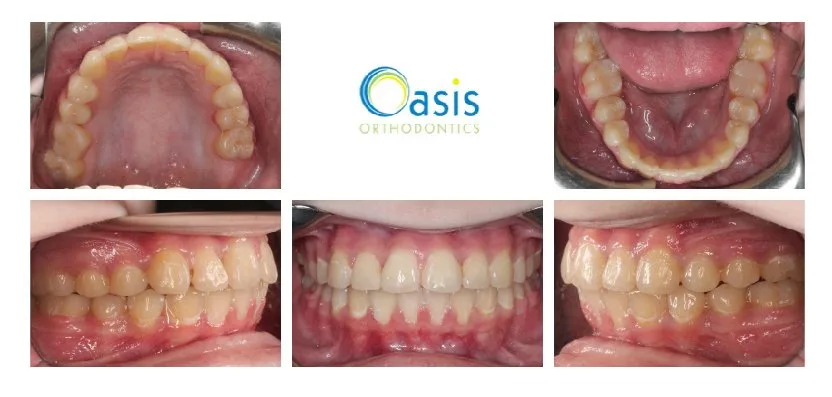 Protruding Teeth after orthodontic treatment