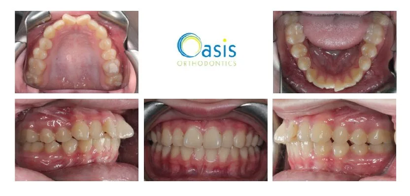 Protruding Teeth before orthodontic treatment