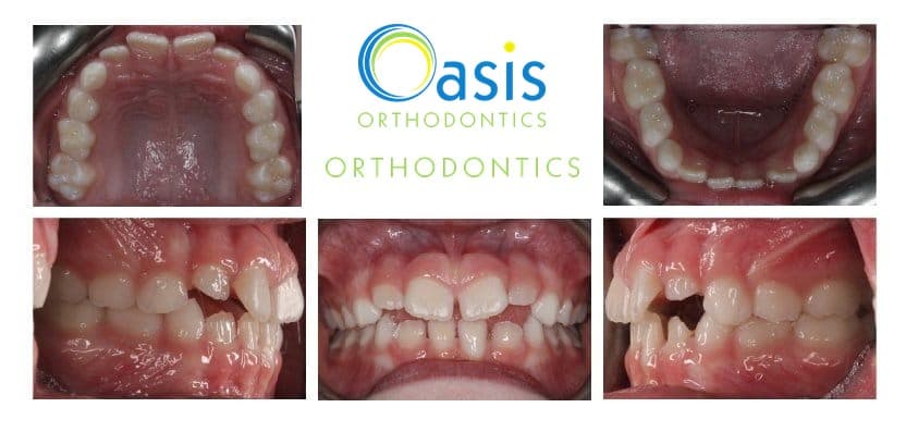 Phase I, pre-teens example 1 before orthodontic treatment