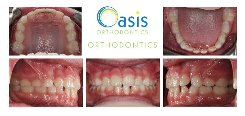 Phase I, pre-teens example 1 after orthodontic treatment