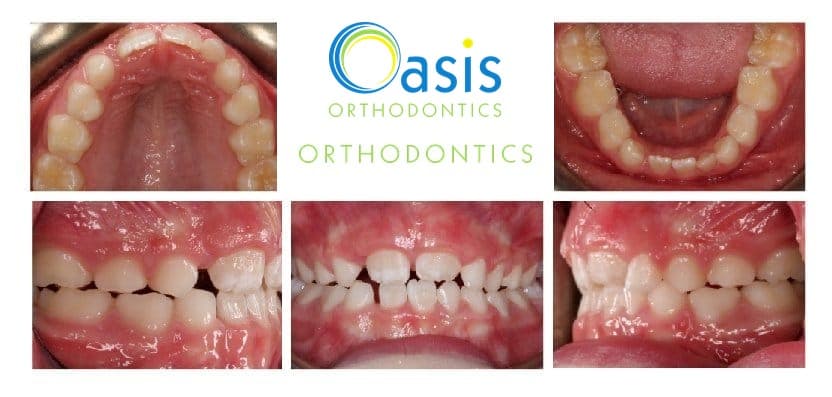 Phase I, pre-teens example 2 before orthodontic treatment