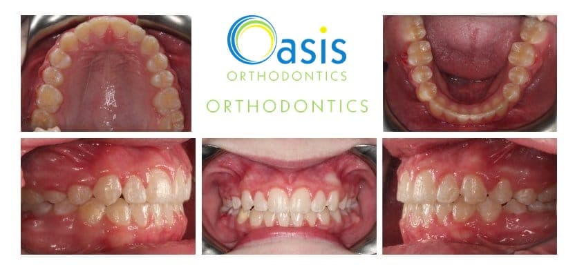 Phase I, pre-teens example 2 after orthodontic treatment