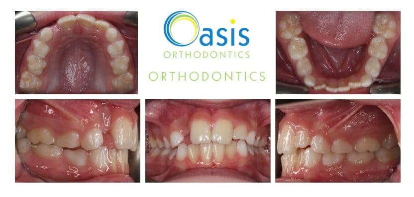 Phase I, pre-teens example 3 before orthodontic treatment