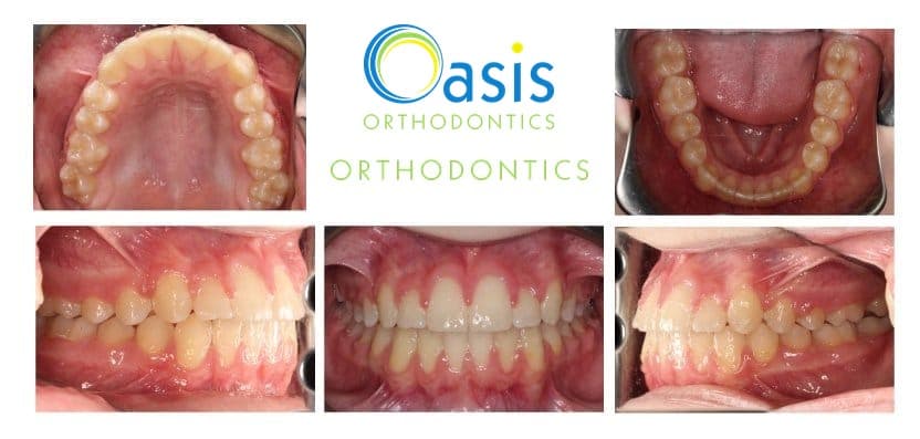 Phase I, pre-teens example 3 after orthodontic treatment