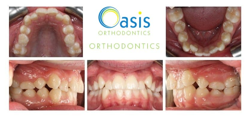 Phase I, pre-teens example 4 before orthodontic treatment