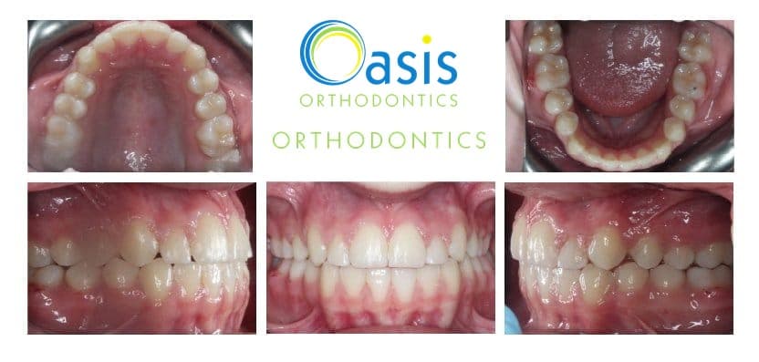 Phase I, pre-teens example 4 after orthodontic treatment