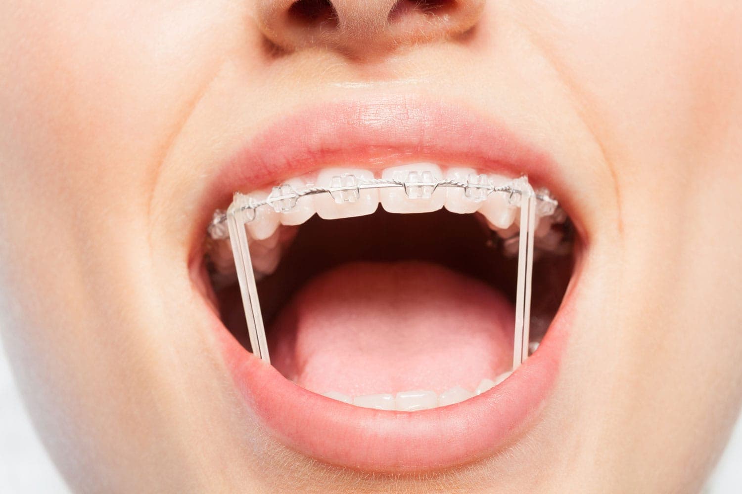Clear braces with orthodontic elastics