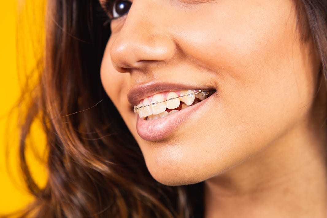 clear braces adults