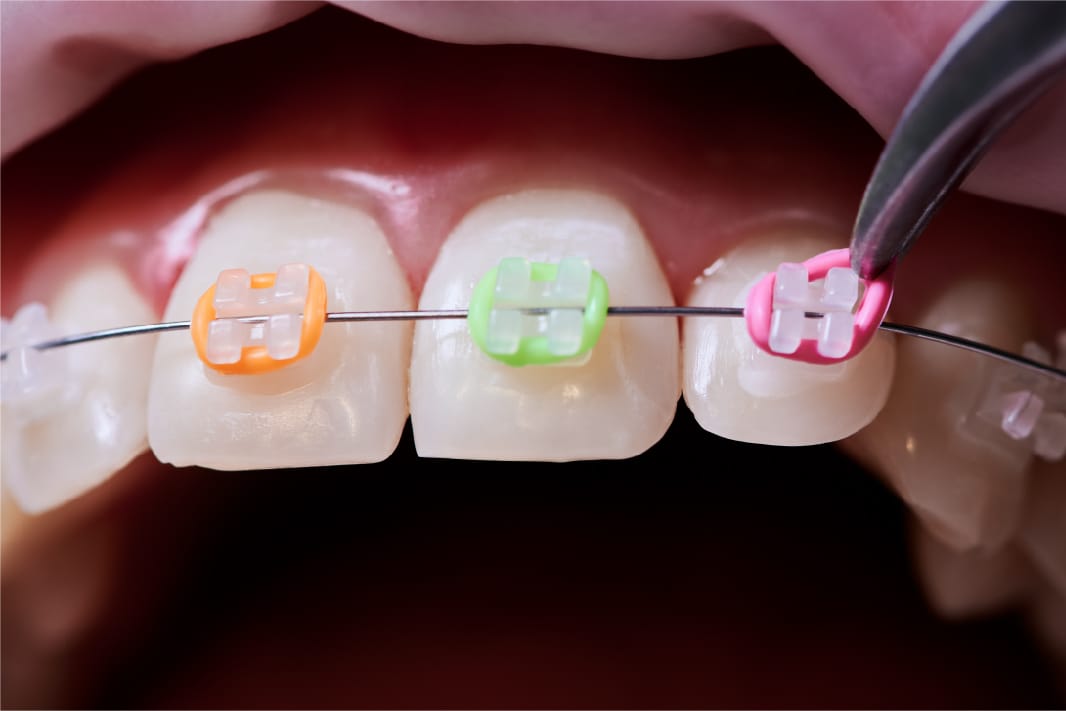 clear braces elastics